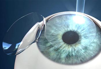 PRK / EPI Lasik doctor in jalandhar